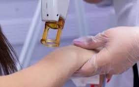 Laser Tattoo Removal